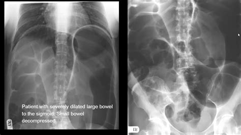 Abnormal Kub Findings For Medical Students Youtube