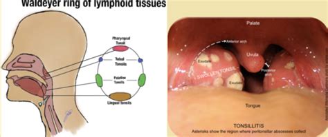 ENT Throat Nose Flashcards Quizlet