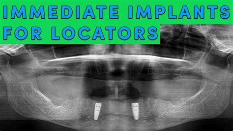 Full Mouth Extractions And Immediate Dental Implant Surgery For Locator