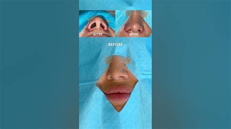 Alarplasty Before And After Nose Job Dr Tanveer Janjua New Jersey Youtube