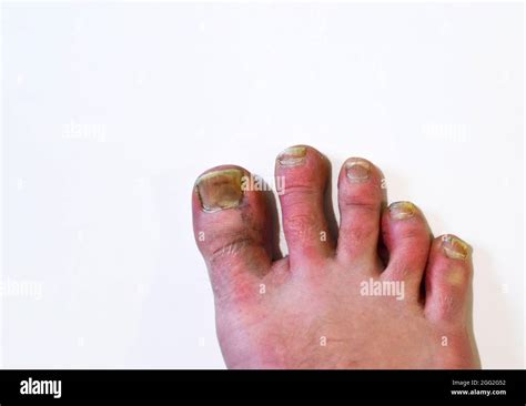 Fungus On Toe Skin