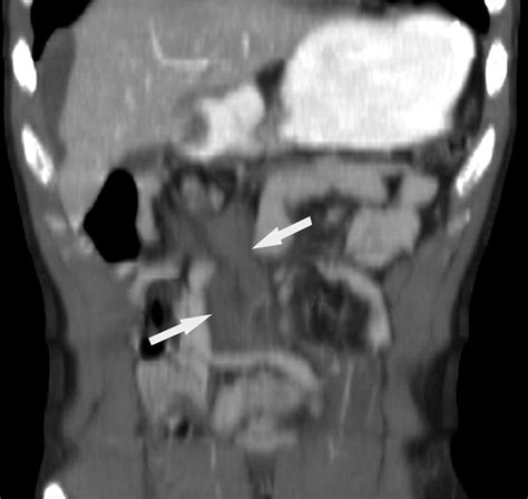 Evaluation Of Bowel And Mesenteric Blunt Trauma With Multidetector CT