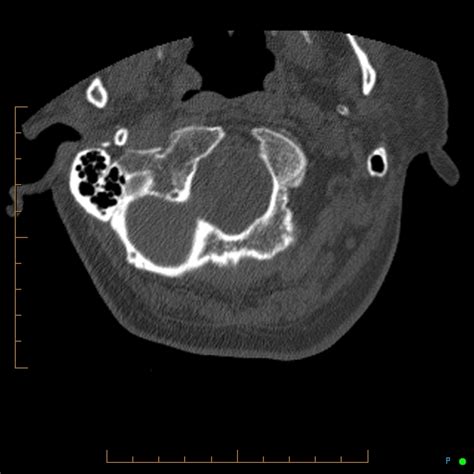 Cervical Spine Fracture Ankylosing Spondylitis Radiopaedia