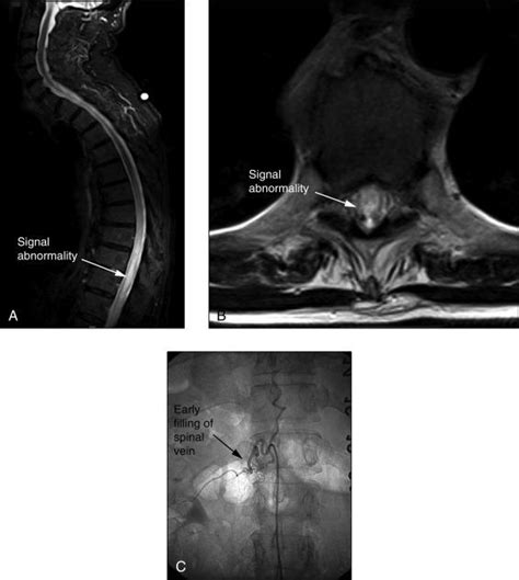 Surgical Management Of Spinal Dural Arteriovenous Fistulas Clinical Tree