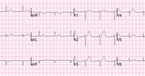 Dr. Smith's ECG Blog: Ten (10) Examples of Hyperacute T-waves in Lead ...