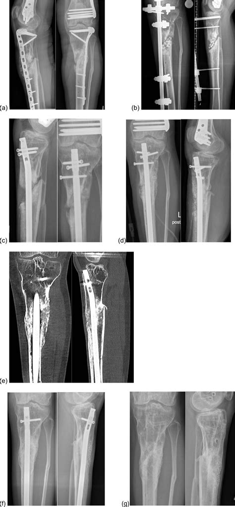 Bioactive Glass In Combination With Autologous Bone Graft In A Patient