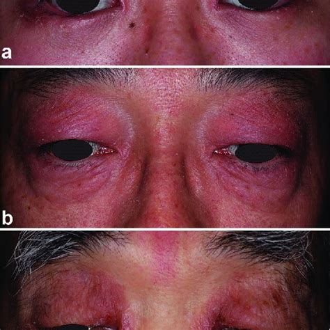 Clinical Features A Case 1 Erythematous Lesions With Flaking Scales