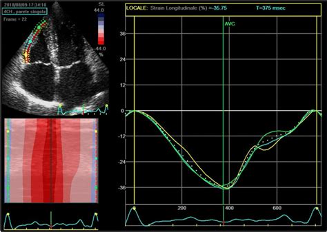 Free Wall Right Ventricular Longitudinal Strain Rvls By The Same