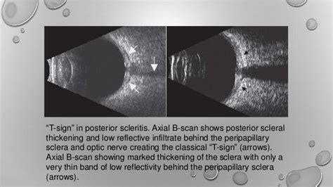 Ultrasound of eye - B scan