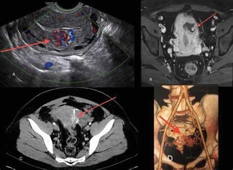 Fertility Pregnancy And Clinical Outcomes After Uterine Arteriovenous