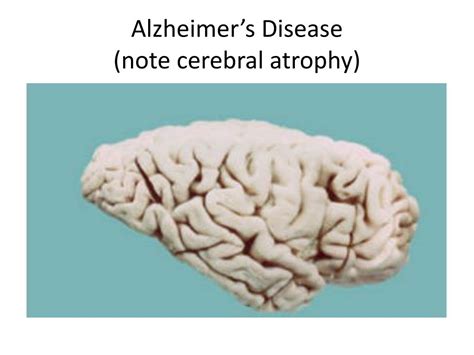PPT - Pathology quiz – CNS 1 PowerPoint Presentation, free download