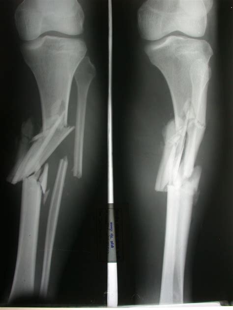 Compound Fracture X Ray