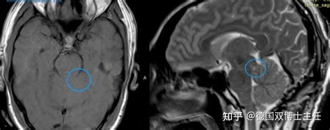 脑干 中脑顶盖胶质瘤常见问题及全切手术治愈性案例汇总 知乎
