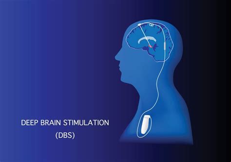 Stimulation C R Brale Profonde Technique Op Ratoire Dr Naoufel