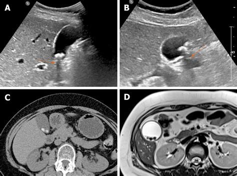 Diseased Gallbladder Ultrasound