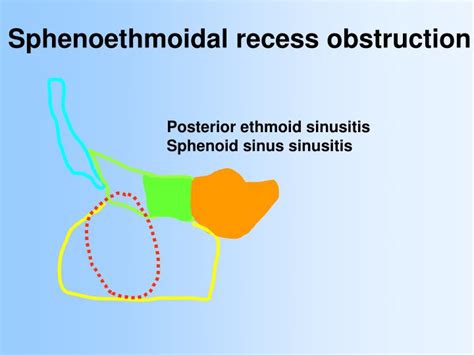 Ppt Anatomy And Relevant Anatomical Variants In Nasal And Paranasal