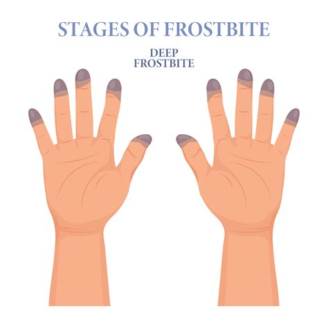 Frozen hands in different stages. Medical frostbite. Stages of ...