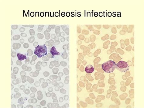 Mononucleosis Infectiosa Infekčná mononukleóza príznaky diagnostika