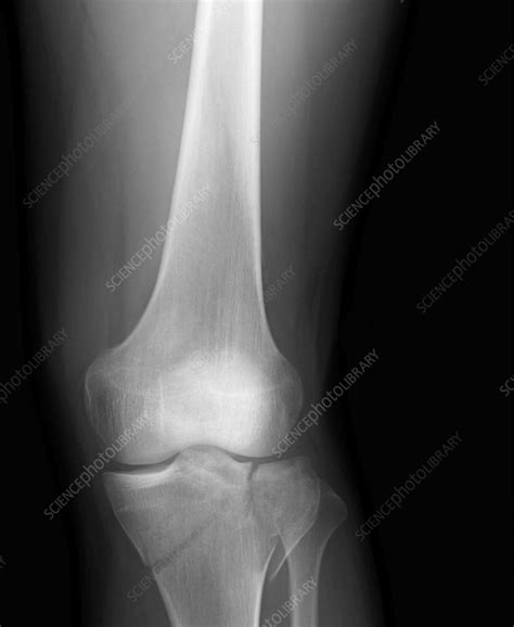 Tibial plateau fracture, X-ray - Stock Image - F036/0263 - Science ...