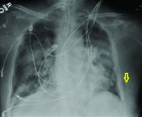 Loculated Pneumothorax With A Deep Sulcus Sign Hernandez The