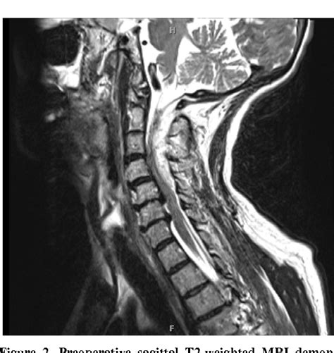 Figure 1 From Spontaneous Cervical Epidural Hematoma Mimicking Stroke