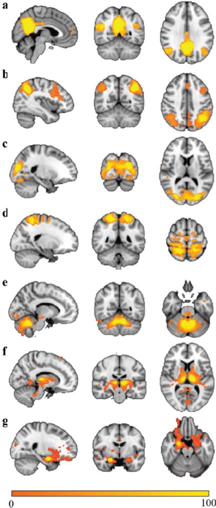 Functional Connectivity From Hks Right Amygdala Coronal And Sagittal