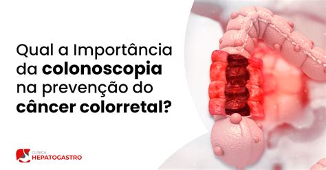 Qual A Importância Da Colonoscopia Na Prevenção Do Câncer Colorretal