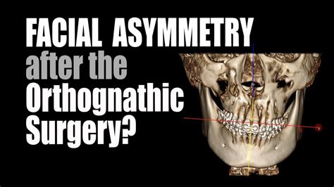 How To Solve The Facial Asymmetry After The Orthognathic Surgery Youtube