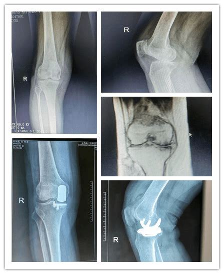 医院首例：膝关节单髁置换术 实现膝骨性关节炎阶梯化治疗全覆盖患者手术药物