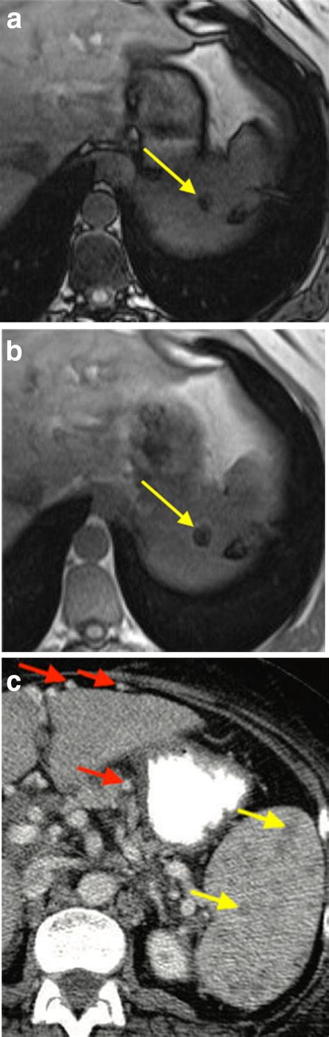 Gamna Gandy Bodies In A Patient With Cirrhosis Out Of Phase A And