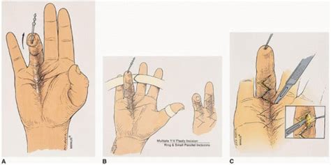 Subtotal Palmar Fasciectomy for Dupuytren’s Contracture ...