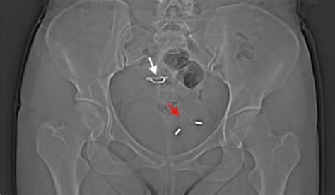 Woman's 'Missing' IUD Turns Up in Her Bladder | Live Science