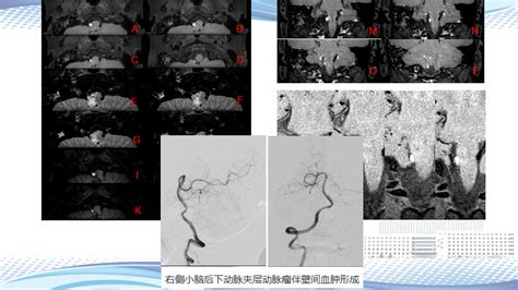 颅内MR高分辨率血管壁成像图像解读