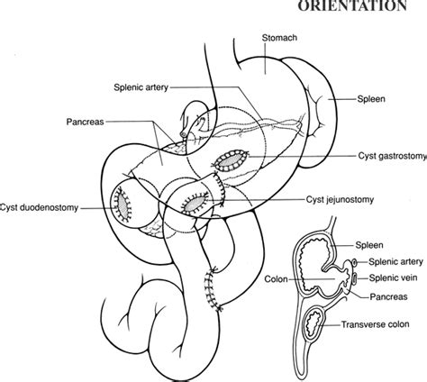 Pancreatic Pseudocyst Drainage