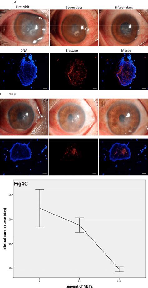 Relationship Between Fungal Keratitis And Net Formation A Slit Lamp Download Scientific