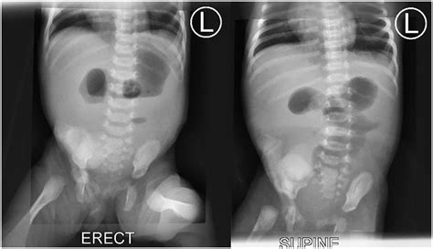 Jejunal Atresia X Ray