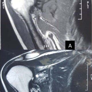 Pdf Overcoming Diagnostic Challenges In Desmoplastic Fibroma Of The