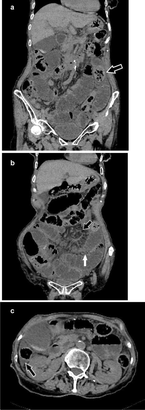 Images In A Year Old Woman With Bi Sbo A Coronal Ct Image Shows An