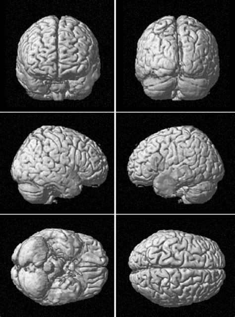 Regions Of Decreased Grey Matter GM Volume From The Comparison Of