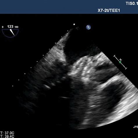 Two Dimensional Transesophageal Echocardiography Showing Atrial Septal