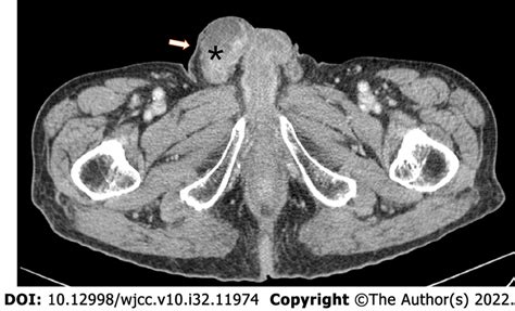 Computed Tomography Urography Image Showing A Mixed Solid Cystic Mass