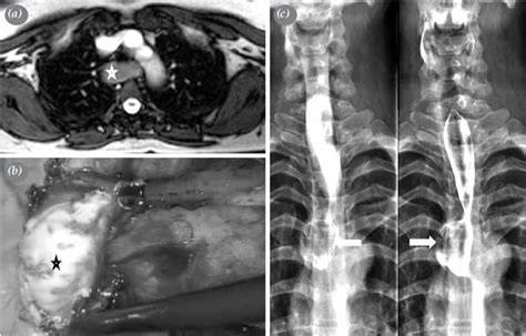 A Magnetic Resonance Imaging Of A 49 Year Old Female Patient With