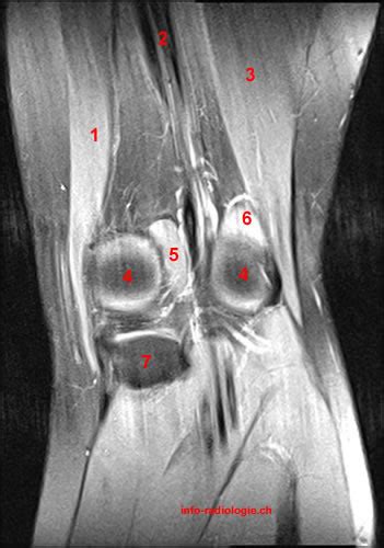 Atlas of Knee MRI Anatomy - W-Radiology