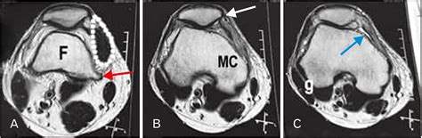 Vastus Medialis Oblique Mri