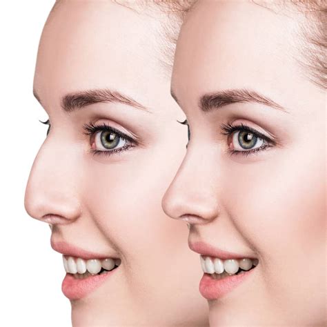 Rhinoplasty Miami Specialist Surgeon Dr Carlos Wolf