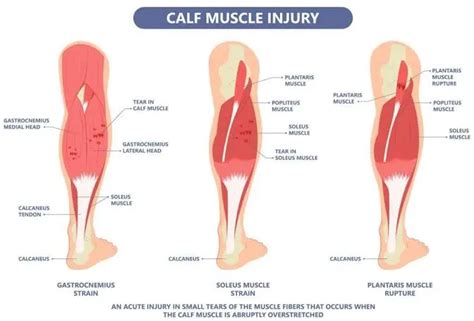 Pulled Calf Muscle Cause Symptoms Treatment