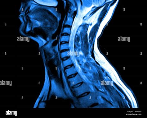 Cervical Spine Mri Hi Res Stock Photography And Images Alamy