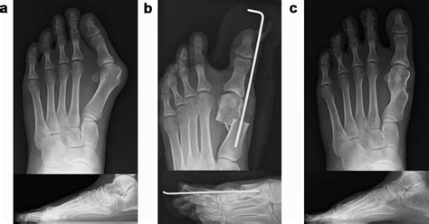 Minimally Invasive Distal Linear Metatarsal Osteotomy Combined With