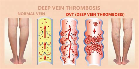 Deep Vein Thrombosis Dvt American Blood Clot Association