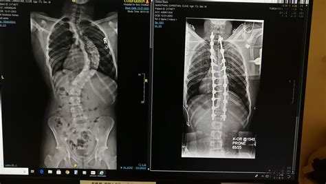 17 male had scoliosis correction surgey for a upper curve of 75 and